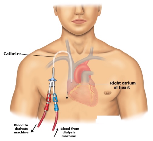 Central venous catheters (CVCs) — temporary or permanent catheters in large veins